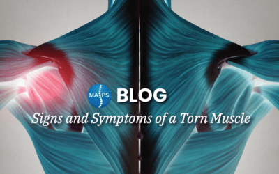 Signs and Symptoms of a Torn Muscle