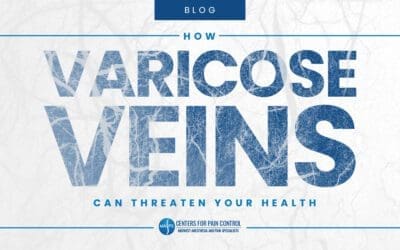 How Varicose Veins Can Be a Threat to Your Health