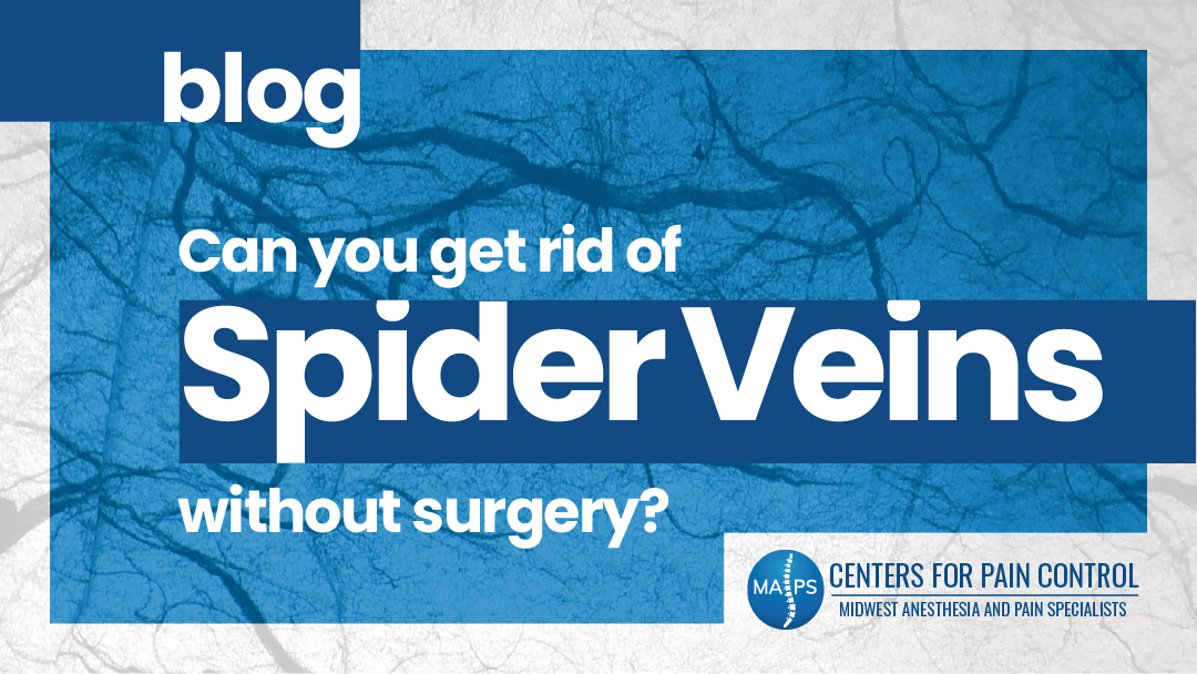 Can You Get Rid of Spider Veins Without Surgery?