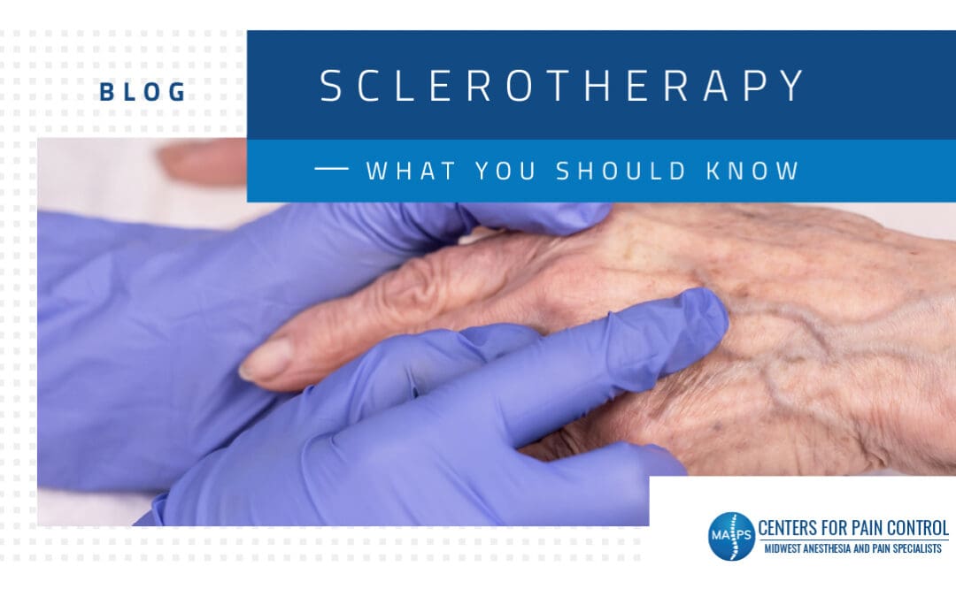What You Should Know About Sclerotherapy for Varicose Veins
