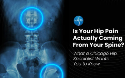Is Your Hip Pain Actually Coming From Your Spine? What a Chicago Hip Specialist Wants You to Know
